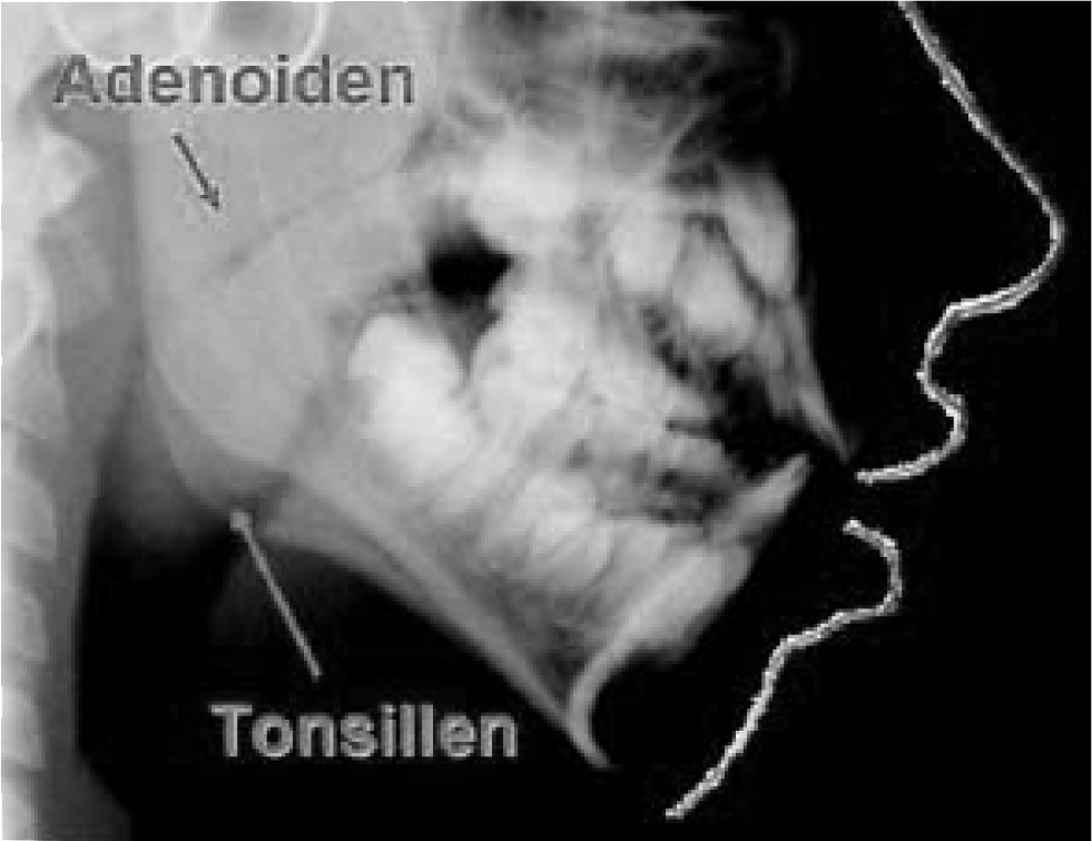 Übergroße Tonsillen und Adenoiden, die eine Mundatmung verursachen.